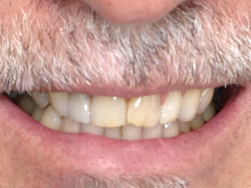 whitening