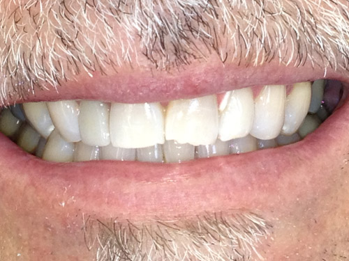 whitening